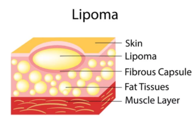 Lipoma Fat Dissolving Injection